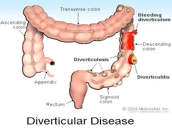 Diverticular_crop_exact