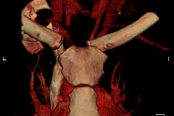 Scdislocation1_crop_north