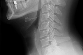439px-cervical_xray_lateral_view_original_crop_north