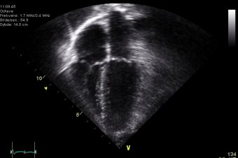Echocardiogram_4chambers_crop_exact.jpg?w=340&h=226&q=85