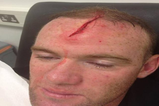 Graphic Image Surfaces Showing Rooney's Injury