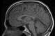 Concussions are not brain "bruises." They are actually injuries that cause changes at the cellular level, and imaging appears normal. Photo from Wikimedia Commons.