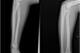 The above picture shows two views of the human forearm. The ulna (toward the left) and radius (toward the right) are clearly seen. Photo from Wikimedia Commons.