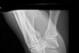 This X-ray shows metal hardware reinforcing one type of forearm fracture. Photo from Wikimedia Commons.