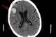 An intracranial bleed—seen on this CT as a white spot amongst normal, gray brain tissue—can necessitate emergency surgery. Photo from Wikimedia Commons.