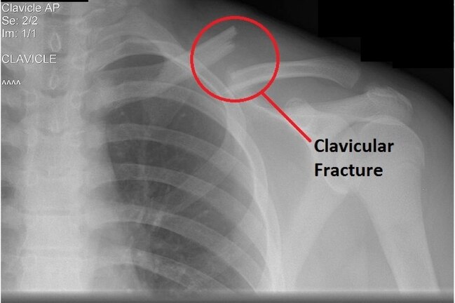 A Closer Look at Aaron Rodgers' Injury, Collarbone Fracture and Future