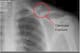 This X-ray shows a significantly displaced fracture of the left clavicle. Most likely, Aaron Rodgers' fracture is not as severe.