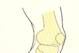 Compartment syndrome can compress the nerves and blood vessels of the leg.