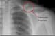 Displaced clavicle fractures—such as the one seen above—require surgery.