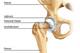 Hip dislocations—when the femur slips out of the acetabulum—can damage the labrum.