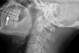 Doctors can discern cervical spine instability from certain types of X-rays and other imaging studies.