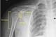 The humerus—or upper arm bone—sits within the glenoid of the scapula, or shoulder socket.
