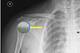 The shoulder mirrors a golf ball sitting on a tee. The golf ball represents the head of the humerus, and the tee represents the glenoid. The labrum is a supportive extension of the "tee," seen in blue above.