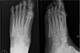 X-rays may not always show a stress fracture.