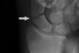 The white arrow in the above X-ray (not Tre Mason's) shows a fracture of the middle portion of the scaphoid.