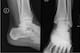 Ankle X-rays that demonstrate increasing separation of the tibia and fibula during stress (not seen here) may suggest an unstable high ankle sprain. The tibia and fibula are the two large bones coming from the top of the above X-rays.
