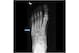 This X-ray shows a Jones fracture, highlighted by the blue arrow.