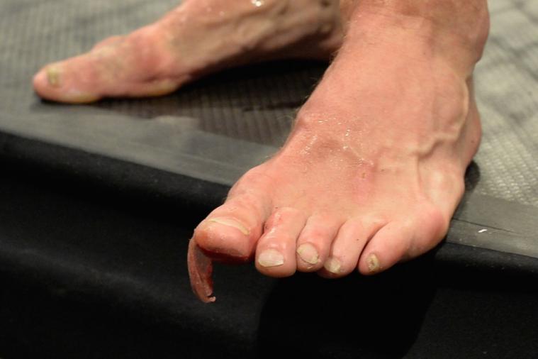 Michael Bisping's Toe Injury Versus Thales Leites Looks Absolutely Gruesome