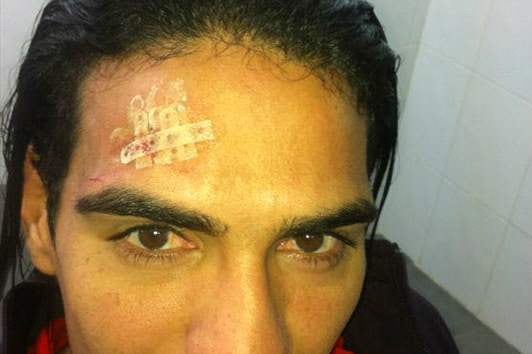 Chelsea Target Falcao Posts Head Injury on Twitter After Collision with Soldado