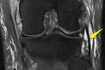 Lclsprain_original_crop_north