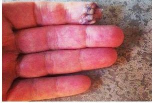 Annika Sorenstam Accidentally Cut off the Tip of Her Finger