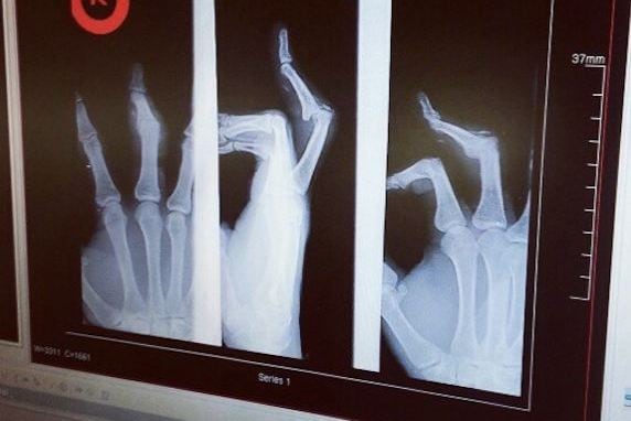 Thomas DeCoud Broken Finger X-Ray