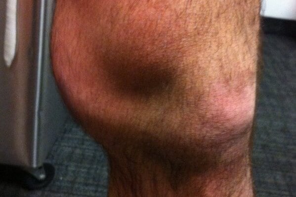 Ryan O'Byrne Tweets Gruesome Photo of Swollen Knee
