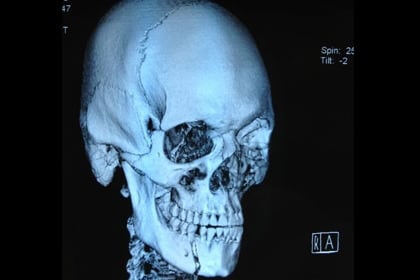 Stefan Struve Tweets X-Ray of Broken Jaw Following KO Loss to Mark Hunt