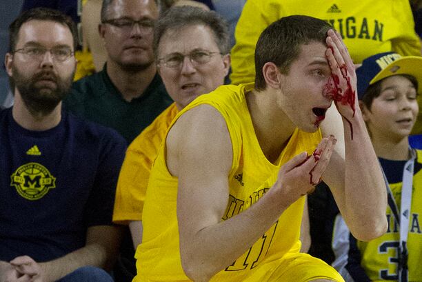 Nik Stauskas: Bloody Eye Injury Requires 12 Stitches (PHOTO)