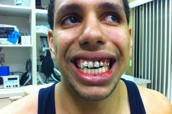 St. Mary's Brad Waldow Has Surgery to Repair Tooth