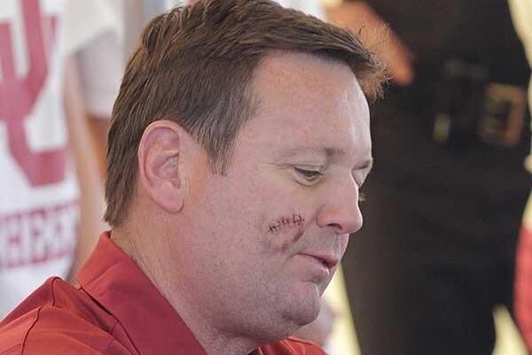 Oklahoma Football Head Coach Bob Stoops Has Pre-Cancerous Spot Removed from Face