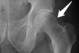 This X-ray of a left hip (not one of Rodriguez) shows prominent bone on the head and neck of the femur (white arrow).