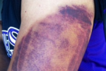 Rockies Pitcher Show Off Bruise from Line Drive