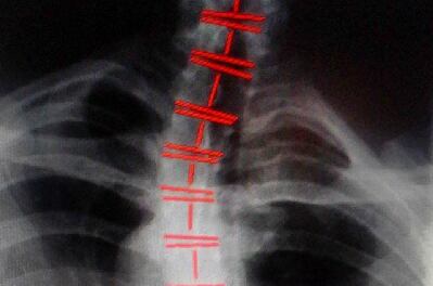 Former WWE Superstar Posts Picture of His Spine After 10 Years in Business