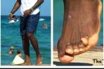 What's Wrong with LeBron's Toes?