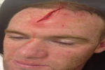 Rooney Reveals Horror Gash Photos 