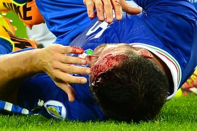 Italy Defender Manuel Pasqual Suffers Horror Cut