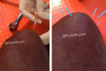 Kobe Posts Pictures of German Knee Procedure