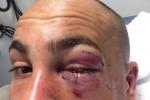 Alvarez Tweets Pic of Stitched Up Left Eye