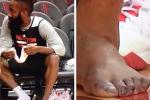 James Harden's Toes Are Really Ugly