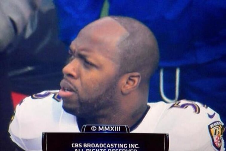 Ravens' Terrell Suggs Is Having Some Issues with His Hairline