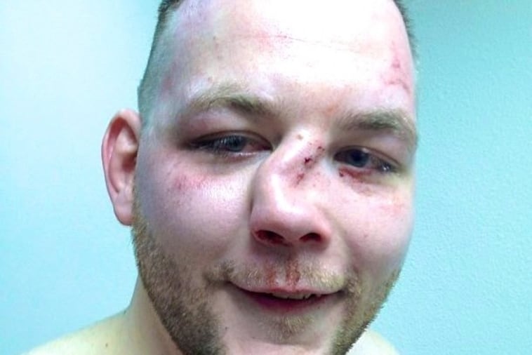 MMA Fighter Andy Eichholz Suffers Nasty Broken Nose