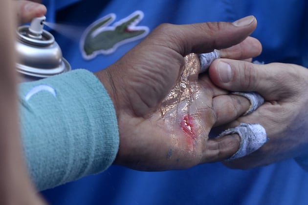 Rafael Nadal's Blistered Hand at Australian Open Match Looks Painful