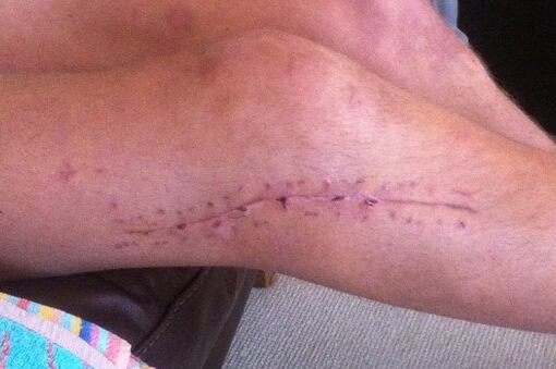 Fans Give £1,000 for Player's Leg Rehab