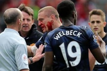 Pic: Vidic's Face Bloodied by Lambert Elbow