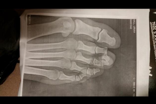 Uriah Hall Shares Picture of X-Ray of Broken Toe