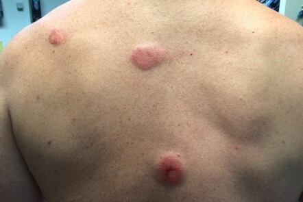 UNC's Fedora Gave One of His Assistants a Ridiculous Welt Playing Paintball