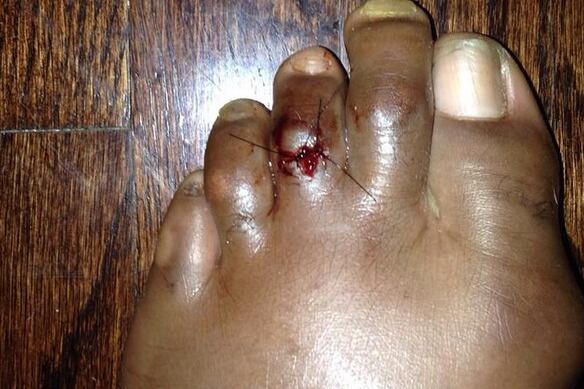 Photo: 'TUF 19' Champ Eddie Gordon Reveals Horrifying Pre-Show Toe Injury