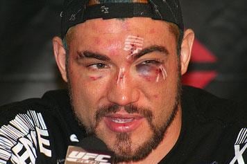 That'll Leave a Mark: The Worst Injuries in UFC History