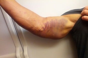 Dear Athletes, Please Stop Tweeting Gross Injury Pics